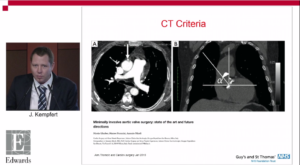 Kempfert thoracotomy