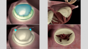 Annulus MV