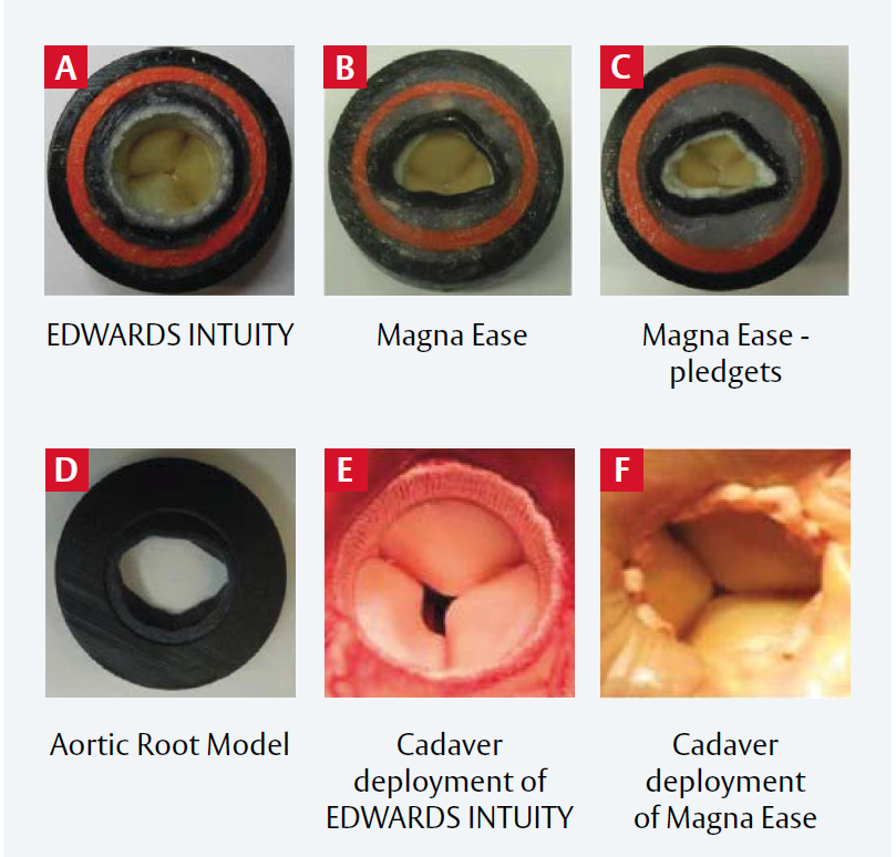 Rapid deployment aortic valves deliver superior hemodynamic performance ...